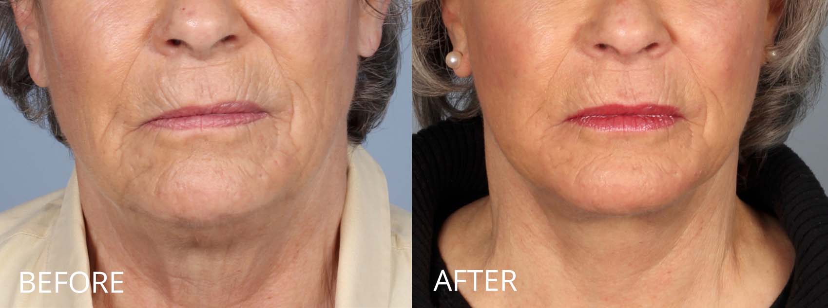 Facelift And Neck Lift Before And After Raval Facial Aesthetics Denver